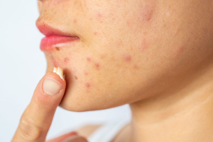 Discover How to Apply Acne Cream for the Best Results Properly