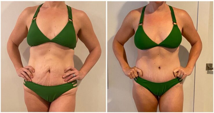 How a Mommy Makeover Can Boost Your Post-Baby Body Confidence